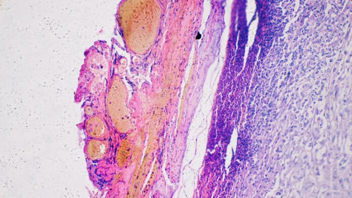 A Personalized Cancer Vaccine Lowers Melanoma Recurrence by 42%
