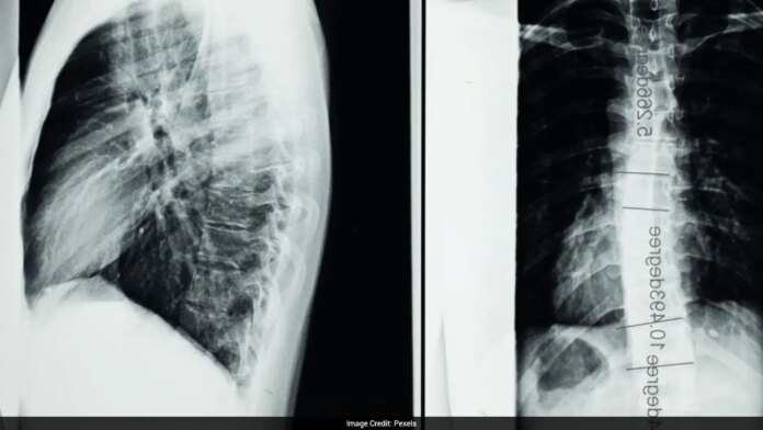 World’s First Spinal Cord Transplant Performed On Paralysed Patient In Russia